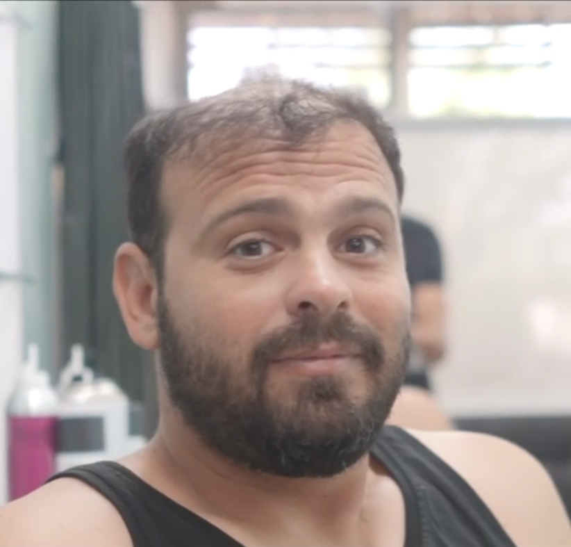 לפני הטיפול - שיער דליל